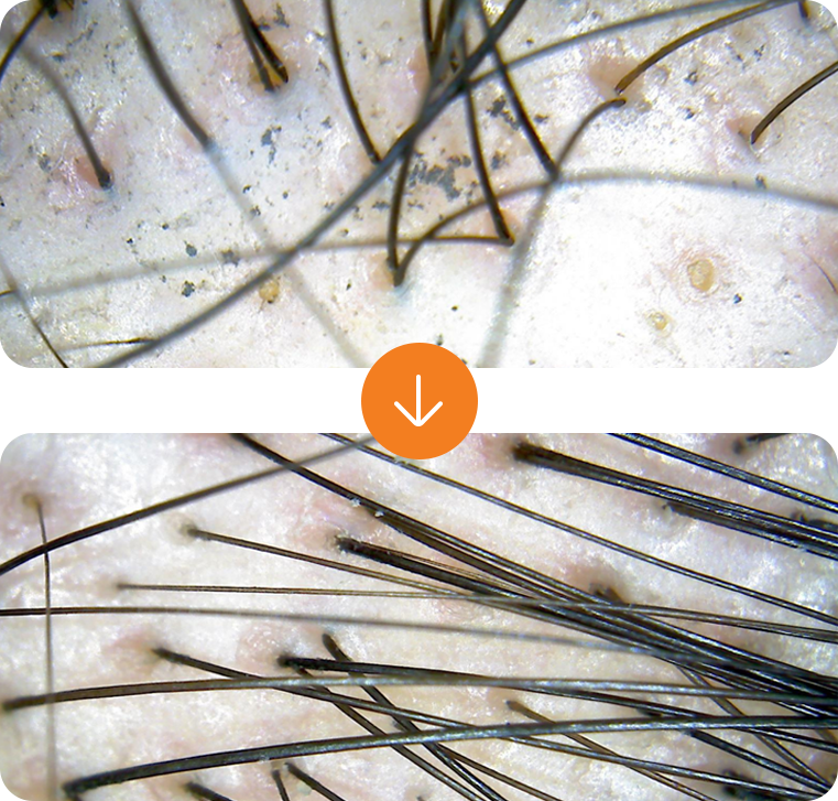 mesotherapy for alopecia,meso hair treatment