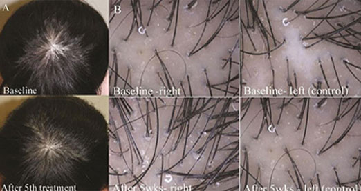 hair follicle regeneration