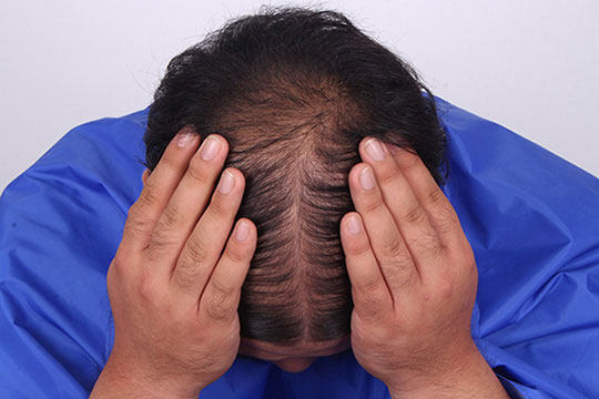 hair follicle regeneration