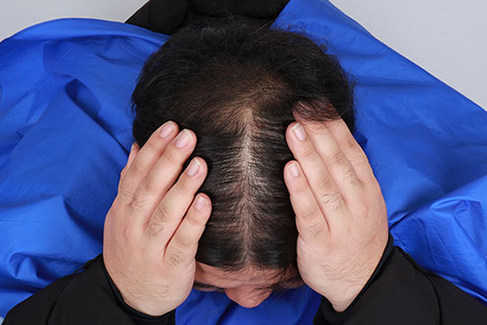 hair follicle regeneration